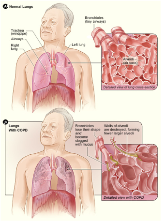Φυσιολογικός πνεύμονας (εικόνα Α) και παθολογοανατομικές αλλοιώσεις του πνεύμονα στην  Χρόνια Αποφρακτική Πνευμονοπάθεια (εικόνα Β)
