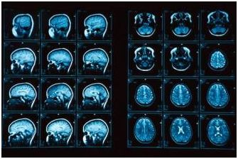 Αξονική τομογραφία εγκεφάλου