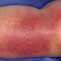 Ερυσίπελας