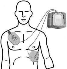 external defibrillator