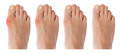 Η πορεία της ουρικής αρθρίτιδας