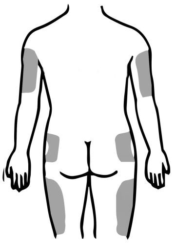 Σημεία ενέσεων ινσουλίνης στην οπίσθια επιφάνεια του σώματος