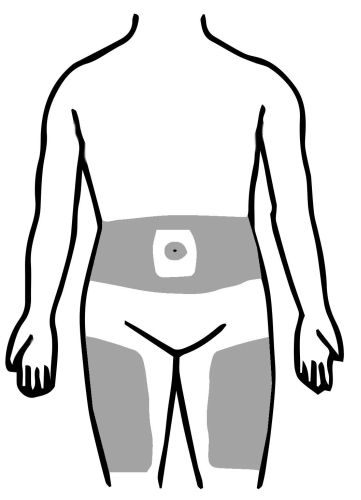 Σημεία ενέσεων ινσουλίνης στην πρόσθια επιφάνεια του σώματος