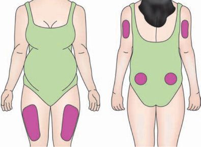 insulin injection pregnant