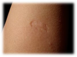 Χηλοειδές μετά από αντιφυματικό εμβολιασμό