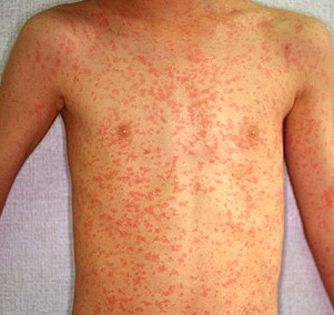 Το εξάνθημα της ιλαράς