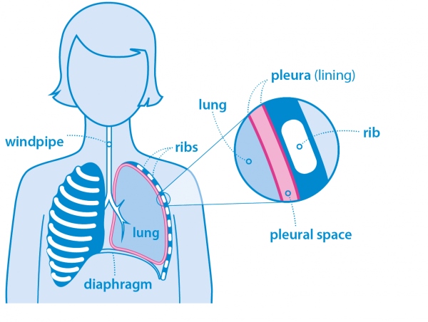 Σχηματική παράσταση ανατομικής θέσης υπεζωκότα