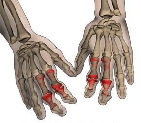 Ρευματοειδής αρθρίτιδα