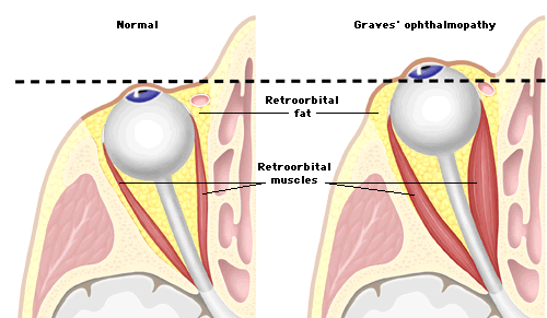 Θυρεοειδική οφθαλμοπάθεια στην νόσο Graves